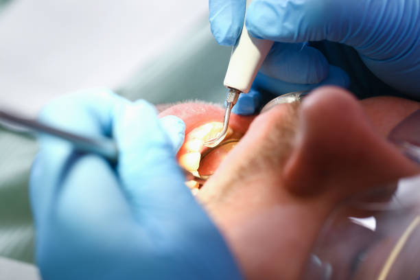 Teeth Whitening in LA